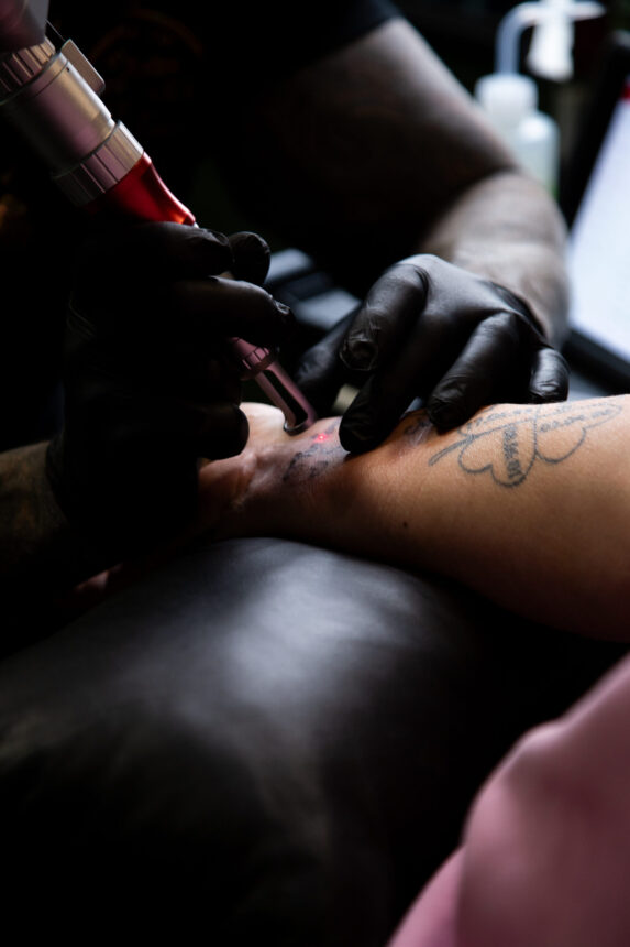Laserfjernelse af tatovering hos House of Body Art i Viborg