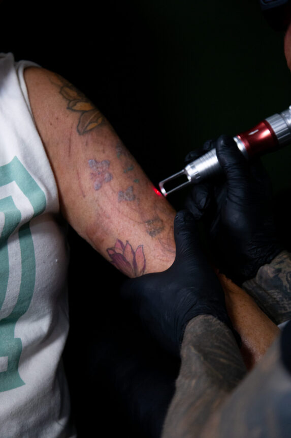 Laserfjernelse af tatovering hos House of Body Art i Viborg
