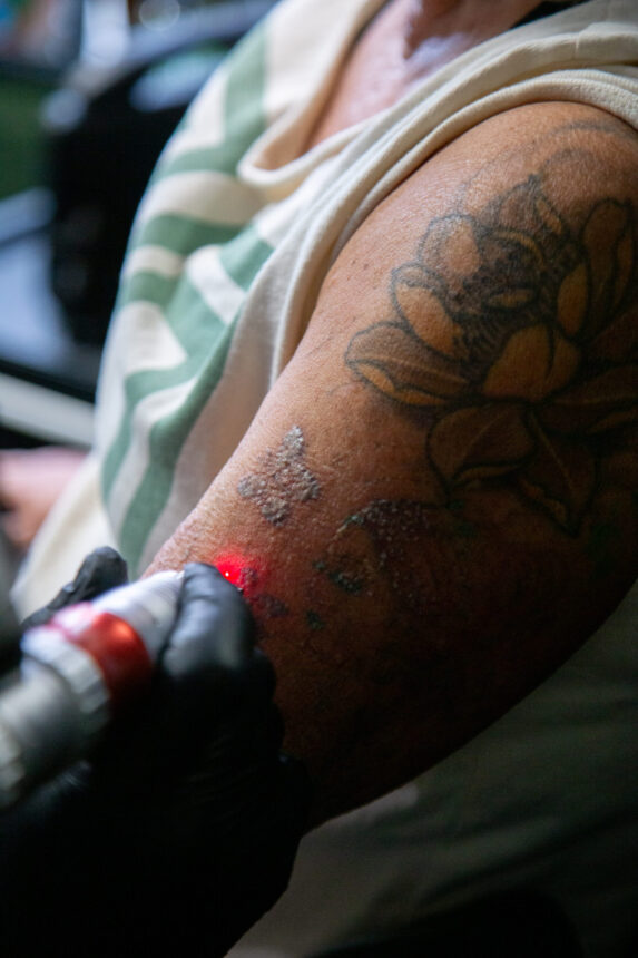 Laserfjernelse af tatovering hos House of Body Art i Viborg